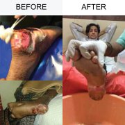 Gangrene Treatment 