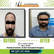 hair transplant result - cosmo hair