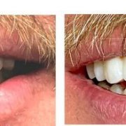 Four Ever Smile Dental Implant Center